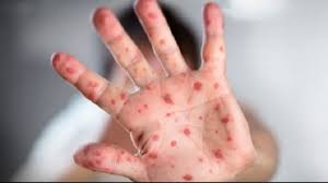 У 2018 році в Європі зареєстровано рекордну кількість випадків кору, більшість з них припадає на Україну