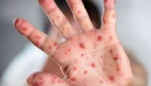 ВООЗ: число випадків захворювання на кір досягла найвищої позначки з 1996 року